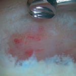Abrasionsarthroplastik