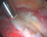 Dekompression bei Cam-Impingement