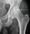Pincer-Impingement im Röntgenbild, vor (links) und nach (rechts) der Hüftarthroskopie