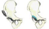 Arthroskopische Behandlung der Hüftpfanne beim Pincer-Impingement.