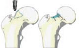 Arthroskopische Behandlung des Oberschenkelhalses. Der knöcherne Anteil, der die Enge verursacht, wird vorsichtig entfernt.