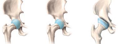 Bei der Arthrose handelt es sich um eine degenerative d. h. fortschreitende Erkrankung. Unbehandelt führt sie schließlich zum kompletten Verlust des Knorpels und Deformationen der knöchernen Strukturen.