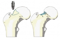 arthroskopische behandlung des oberschenkelhalses athletikum group dr michael lehmann und kollegen