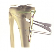 darstellung einer oeffnenden osteotomie mit anlage einer platte