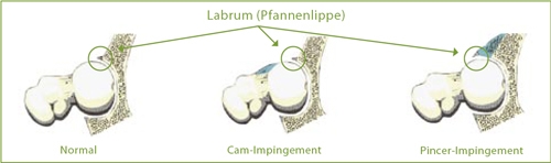 hueftgelenk impingements im vergleich dr michael lehmann