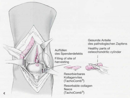 osteochondrale transplantation am sprunggelenk