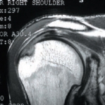 praezise schadensdarstellung im mri