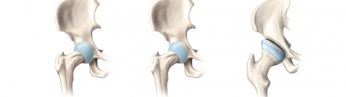 stufen der hueftarthrose dr michael lehmann